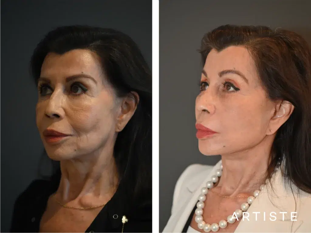77 Years Old: Female Face And Neck Lift