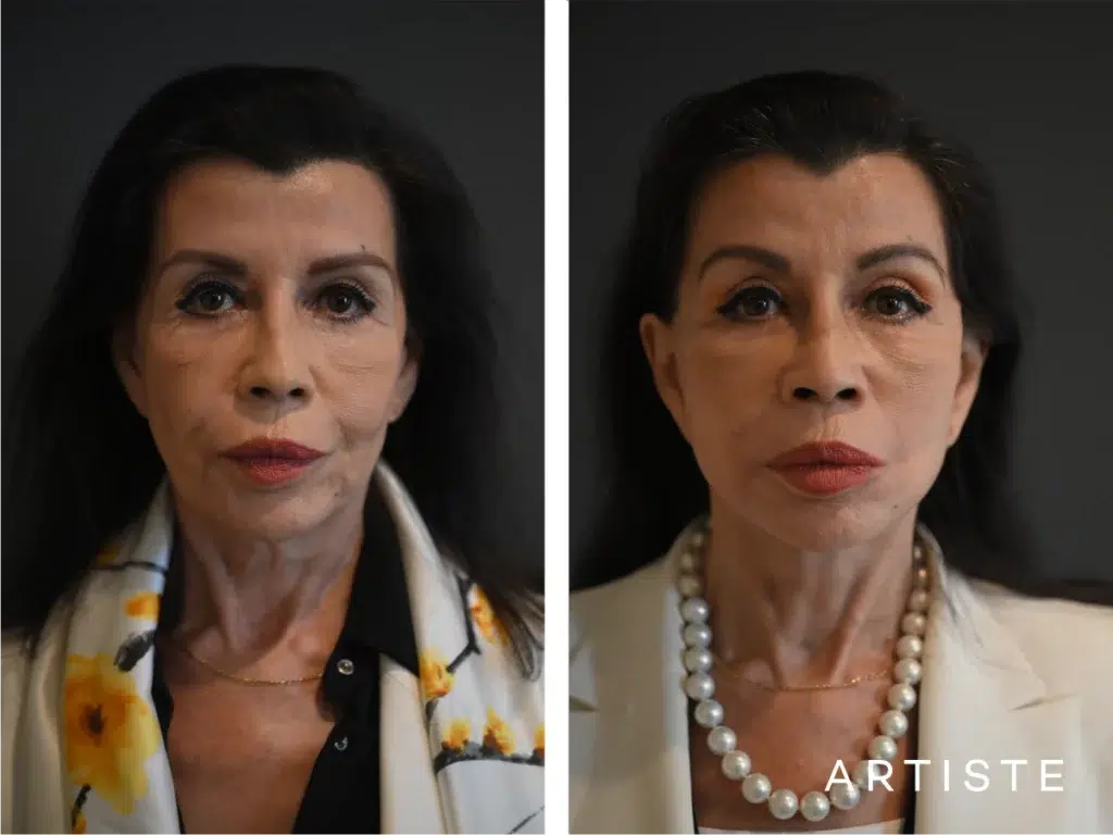 77 Years Old: Female Face And Neck Lift