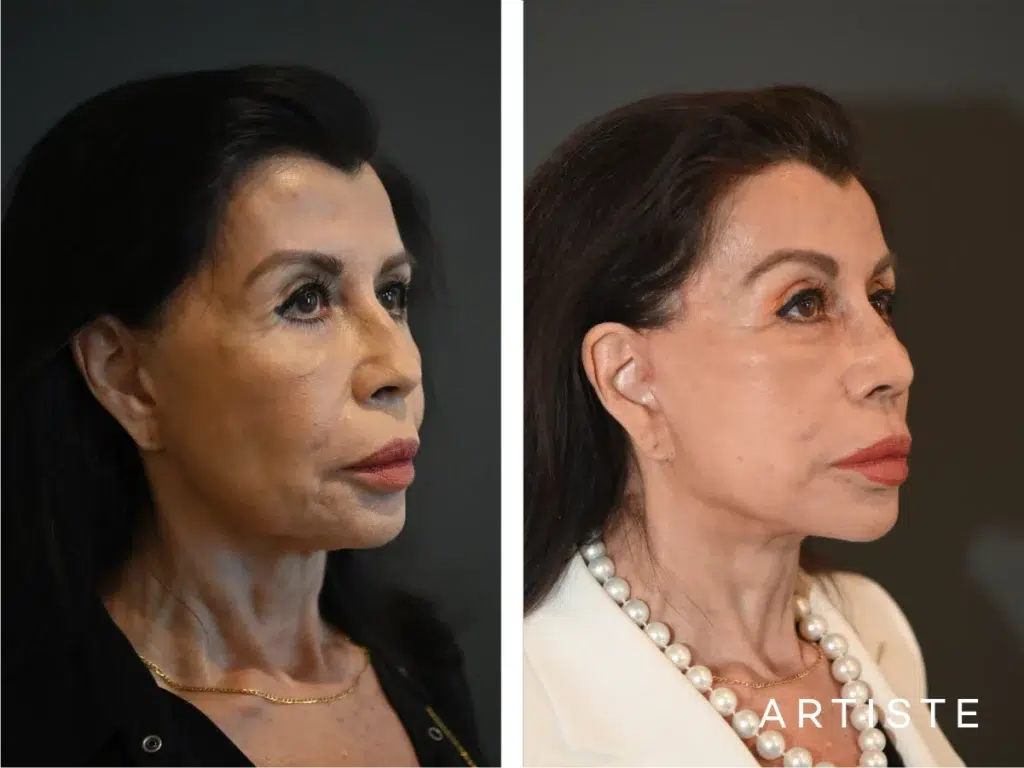 77 Years Old: Female Face And Neck Lift