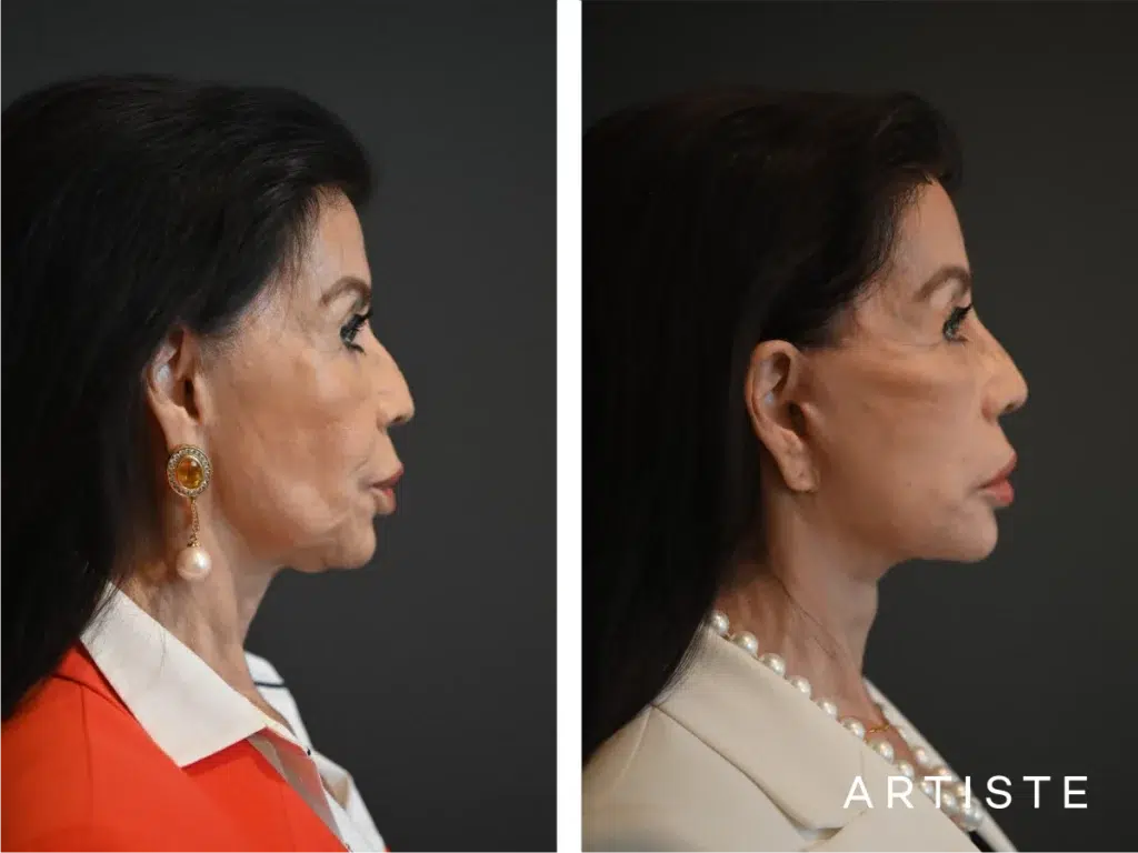 77 Years Old: Female Face And Neck Lift