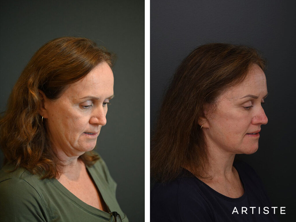 High SMAS Face and Neck Lift, Upper Eyelids, Brow Lift and Lip lift dermabrasion and peel 12 months post