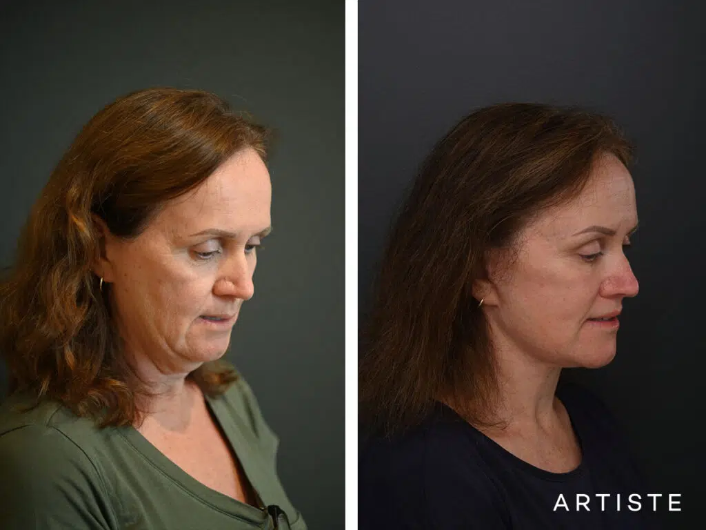 High SMAS Face and Neck Lift, Upper Eyelids, Brow Lift and Lip lift dermabrasion and peel 12 months post
