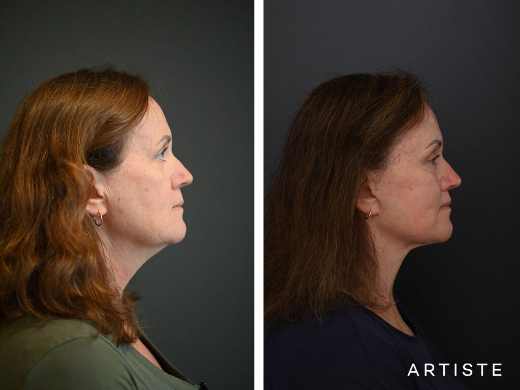 High SMAS Face and Neck Lift, Upper Eyelids, Brow Lift and Lip lift dermabrasion and peel 12 months post