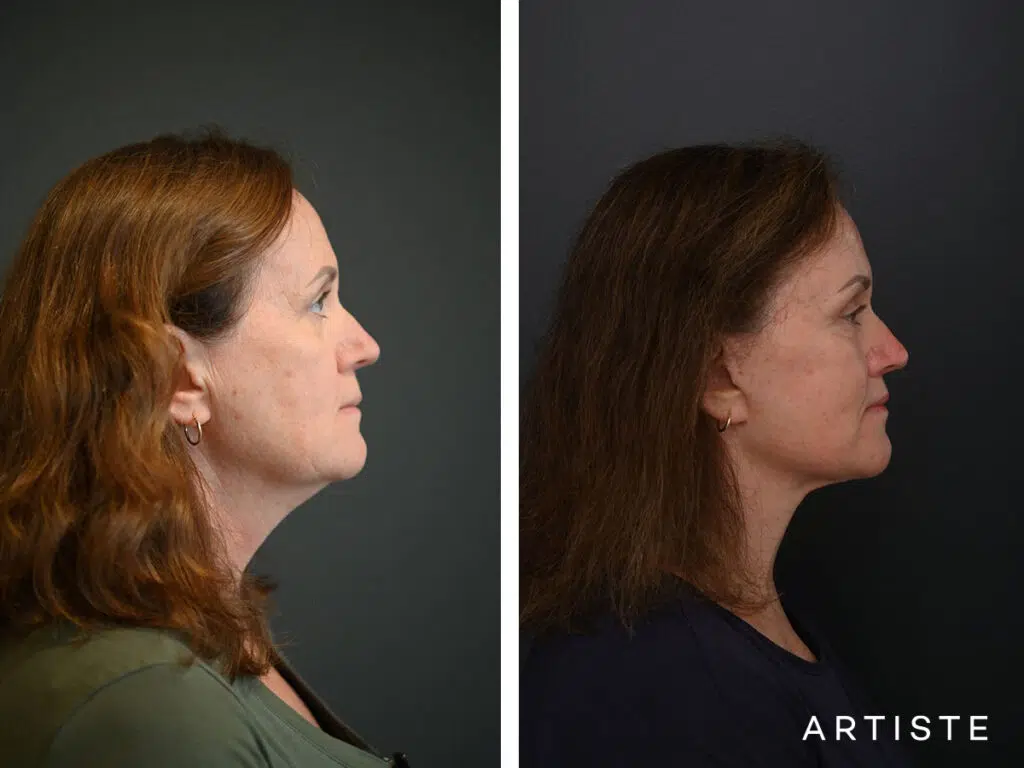 High SMAS Face and Neck Lift, Upper Eyelids, Brow Lift and Lip lift dermabrasion and peel 12 months post
