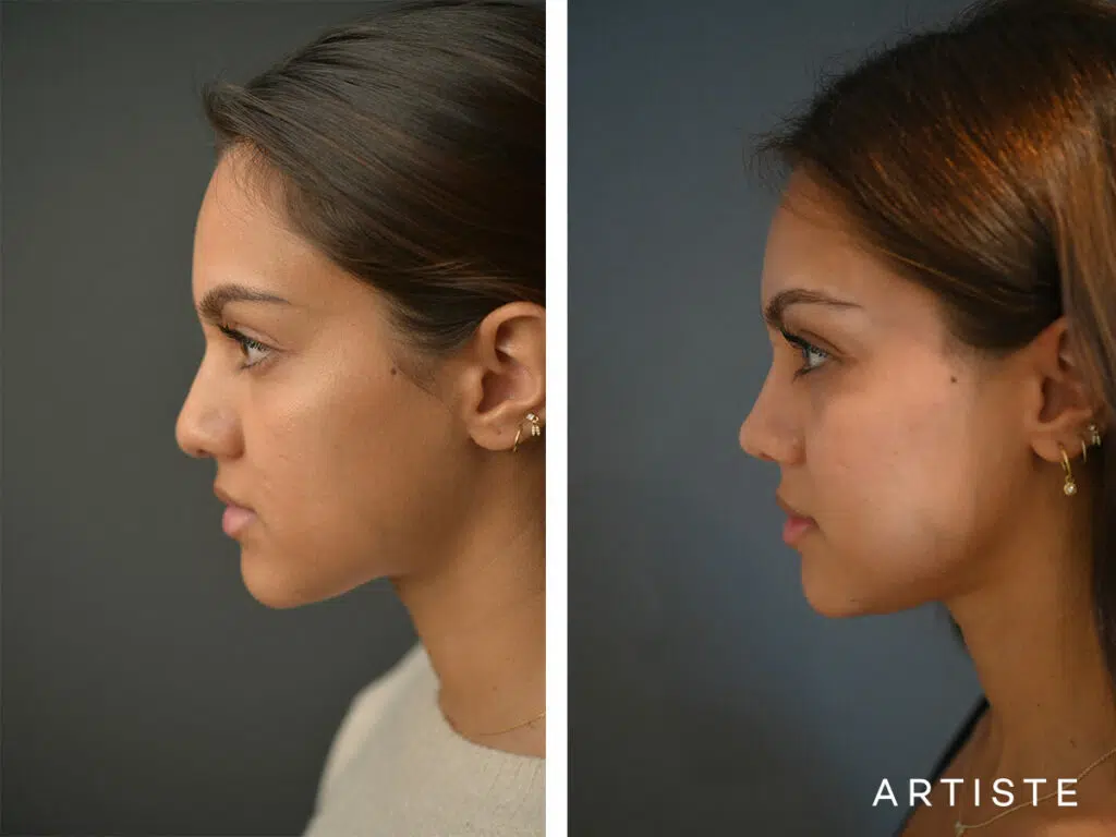 24 Years Old: Ethnic Open Rhinoplasty