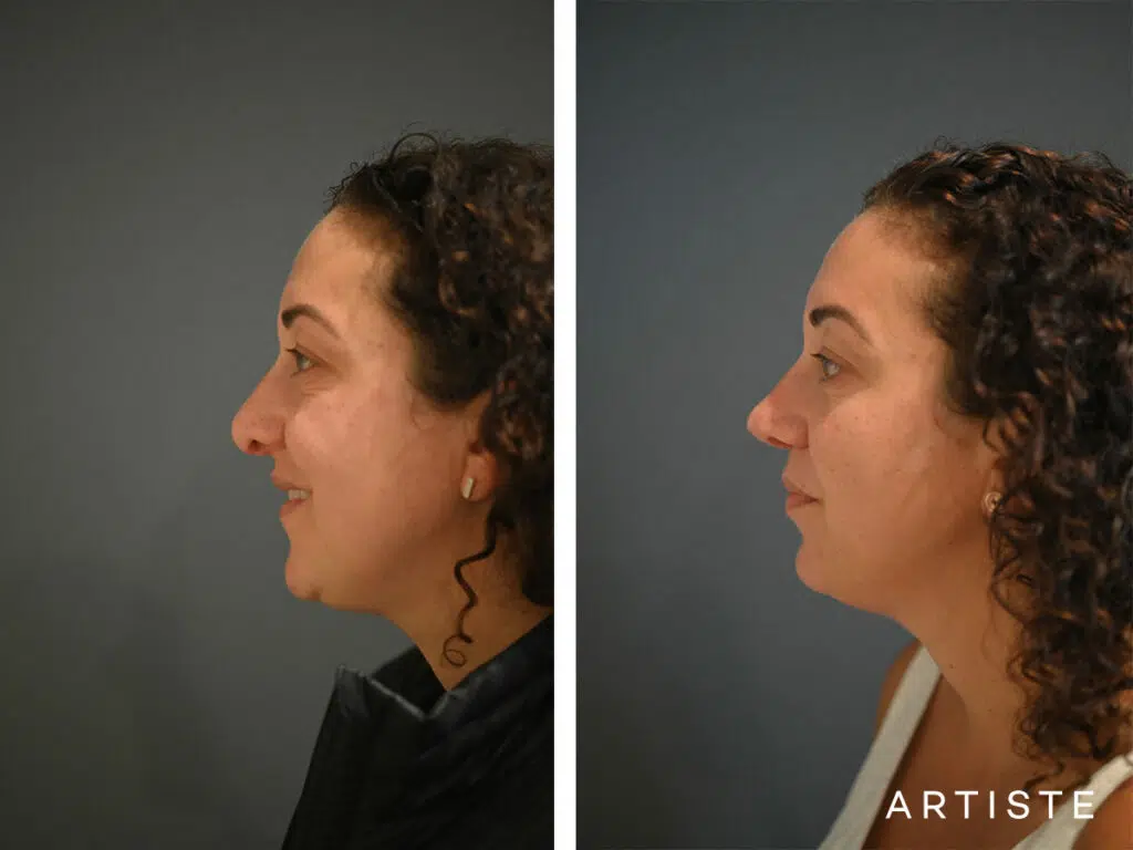 39 Years Old: Reconstructive Rib Graft Revision Rhinoplasty