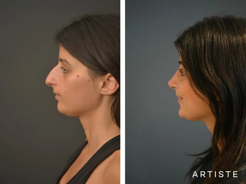 32 Years Old: + 12 months Post Open Structure Rhinoplasty