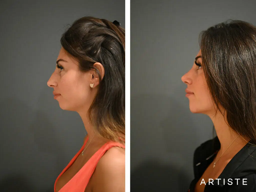 29 Years Old: 12 months Post Open Rhinoplasty and Chin (Implant) Augmentation