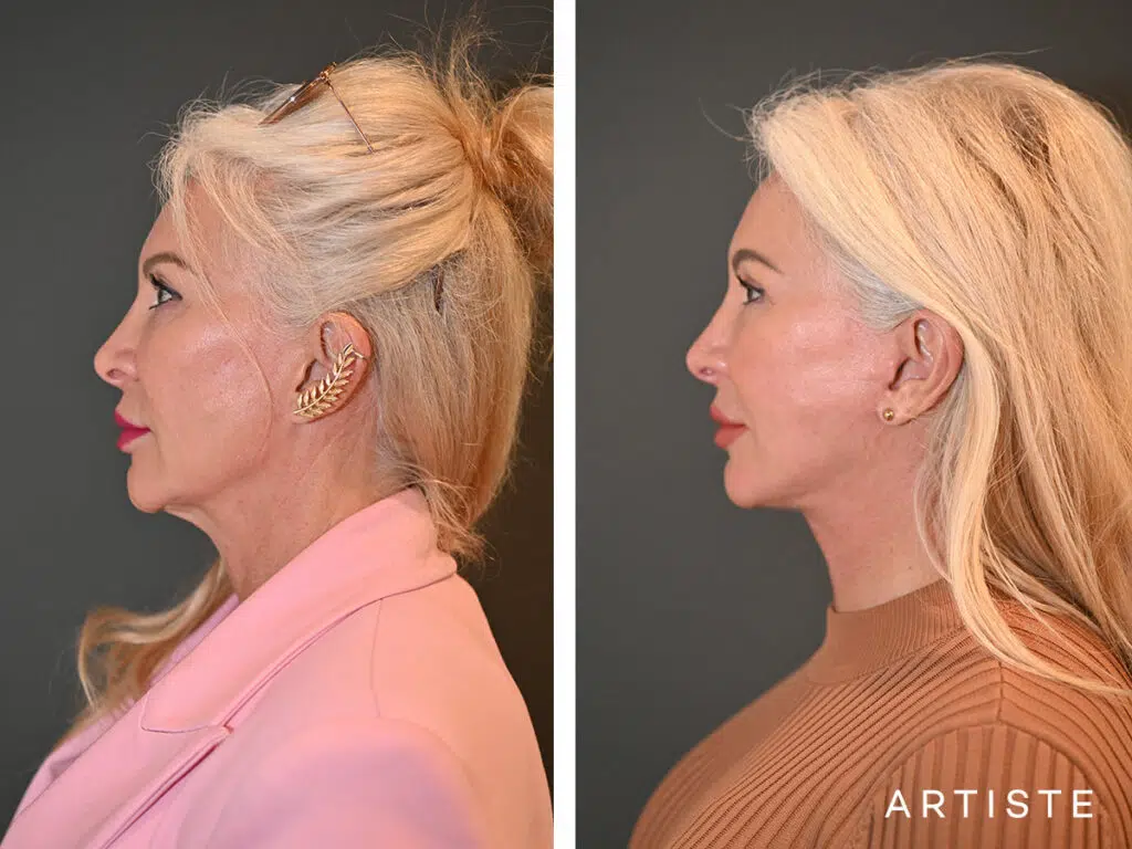 65 Years Old: Deep Plane Neck Lift and Upper Eyelid Blepharoplasty