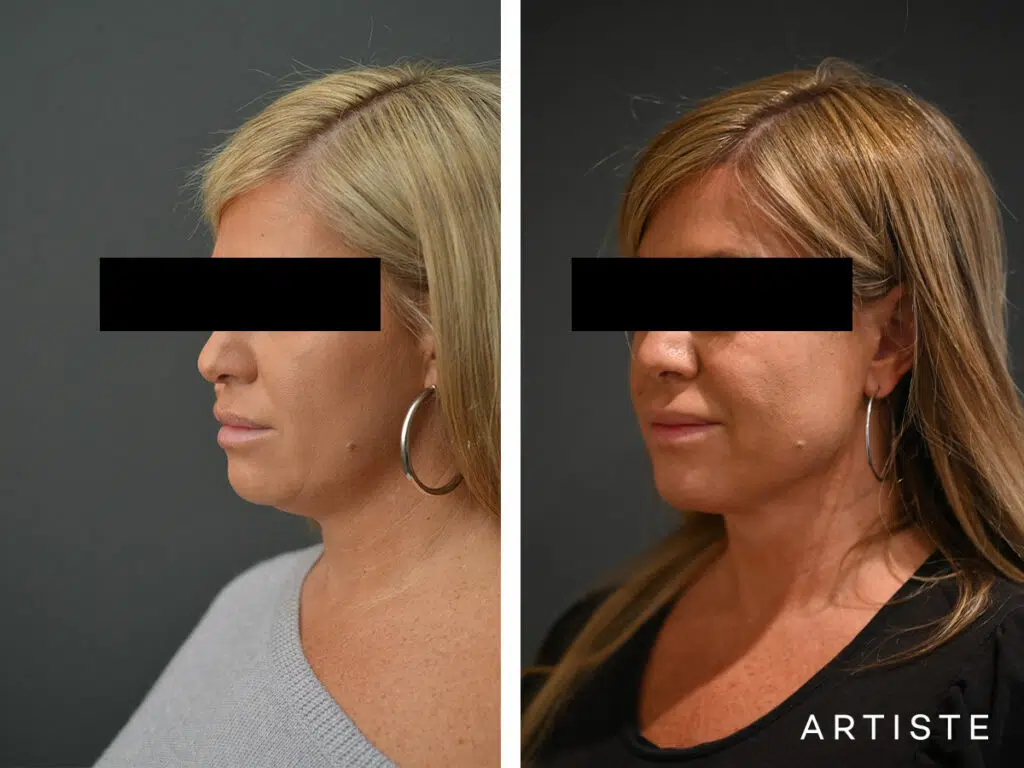 39 Years Old: Neck Sculpt Liposuction