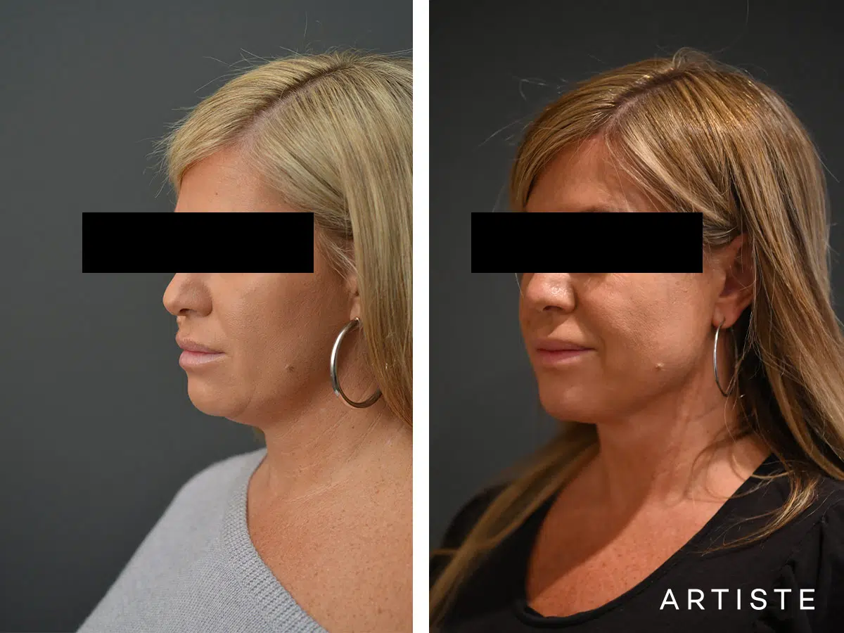 38 F After Liposuction Neck and Back