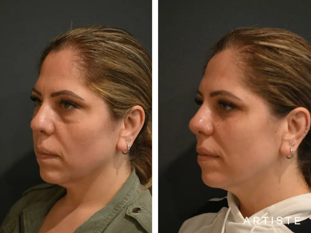 40 Years Old: Lower Eyelid Blepharoplasty