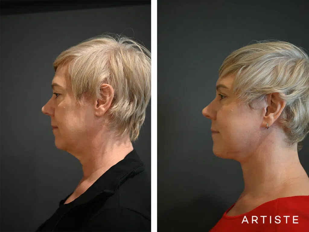 51 Years Old: Deep Plane Face and Neck Lift, Micro Fat Grafting and Bilateral Upper and Lower Eyelid Blepharoplasty