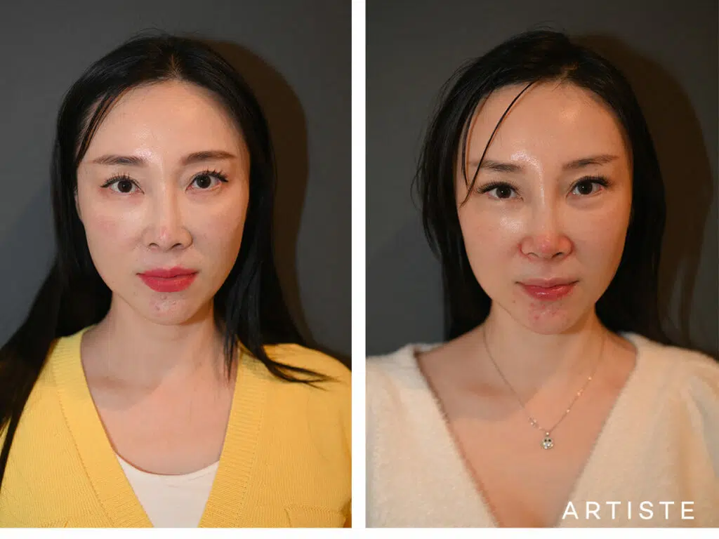 43 Years Old: Silicone Implant and Ear Cartilage Nose Augmentation and Lateral Brow Lift