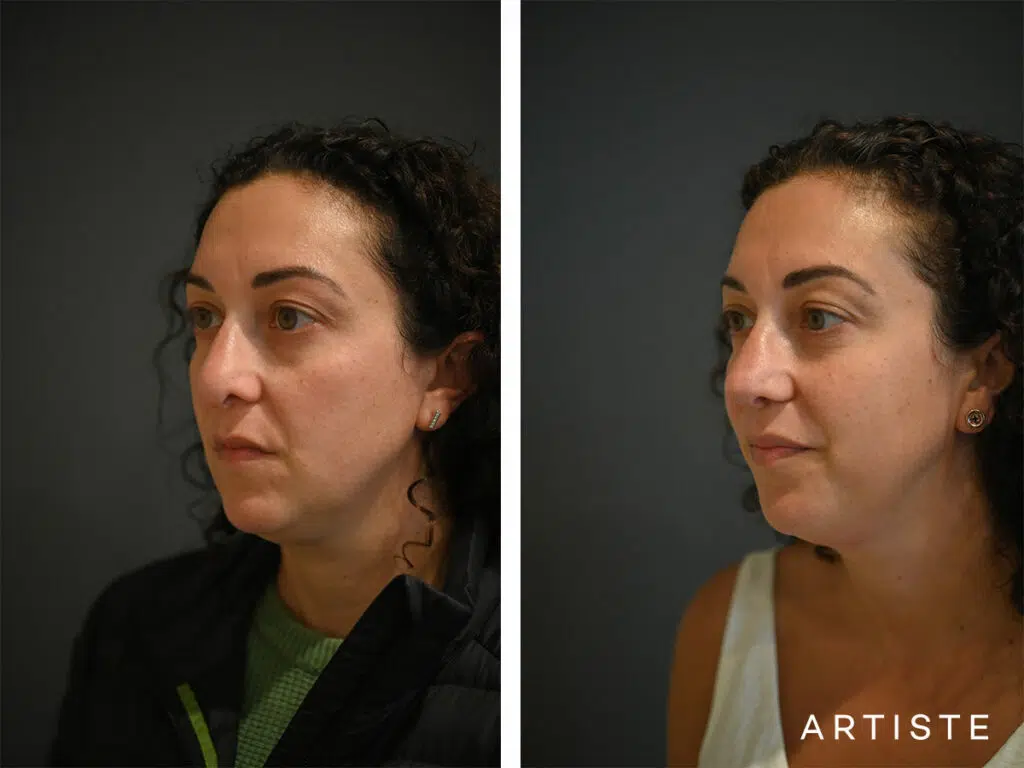 39 Years Old: Reconstructive Rib Graft Revision Rhinoplasty