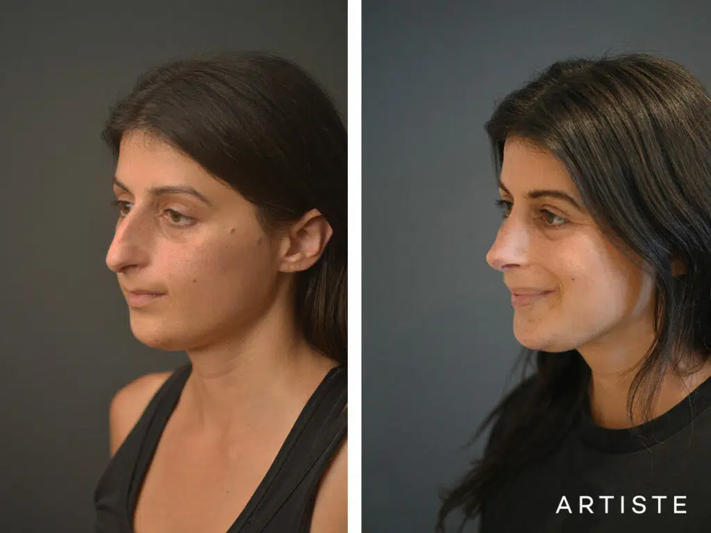 32 Years Old: + 12 months Post Open Structure Rhinoplasty