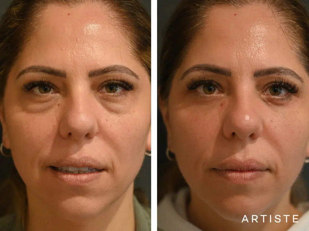 40 Years Old: Lower Eyelid Blepharoplasty