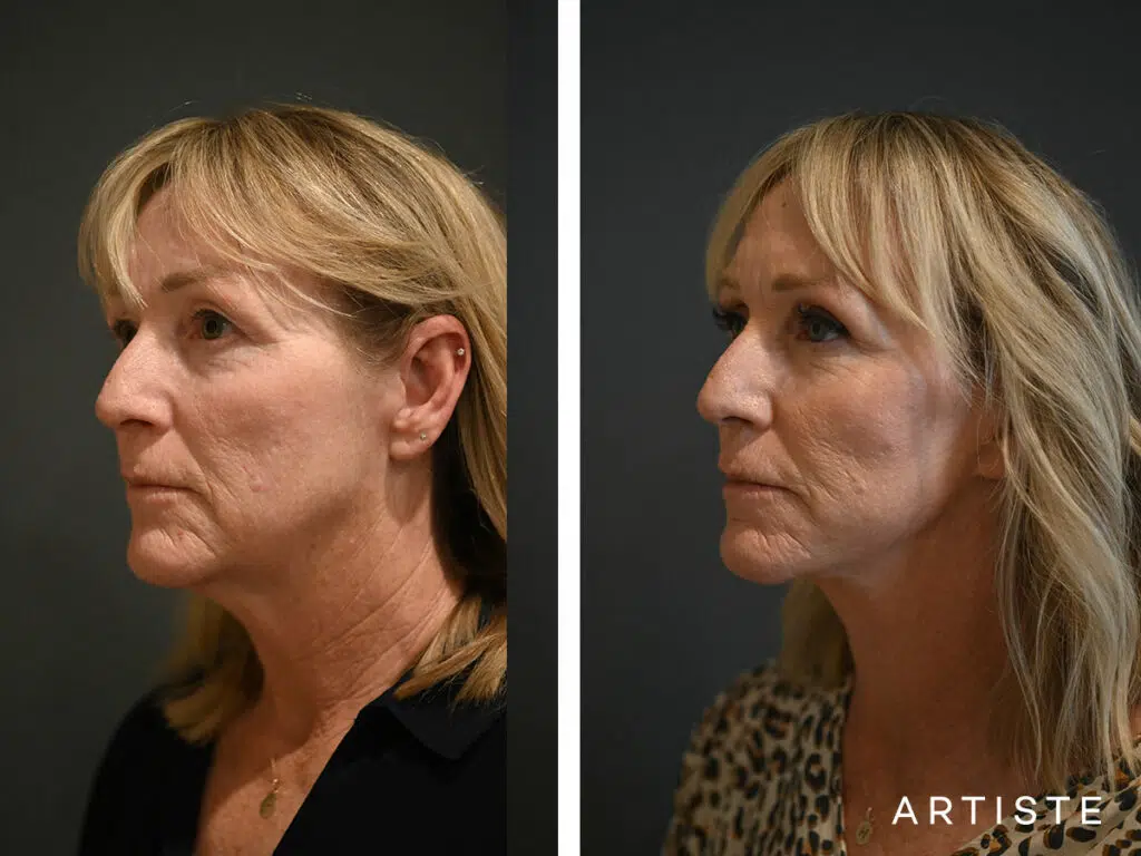 52 Years Old: Deep Plane Facelift, Micro Fat Grafting, Upper Eyelid Blepharoplasty, Peri-Oral Dermabrasion and Chemical Peel