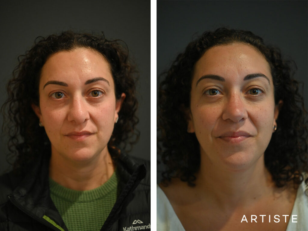 39 Years Old: Reconstructive Rib Graft Revision Rhinoplasty