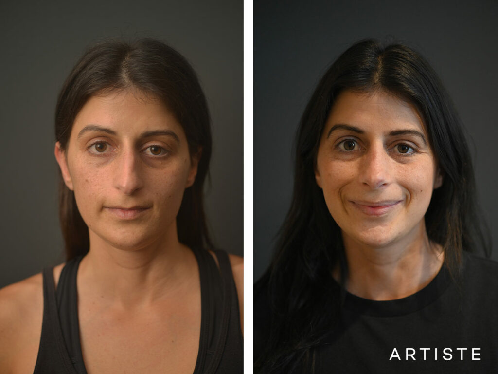 32 Years Old: + 12 months Post Open Structure Rhinoplasty
