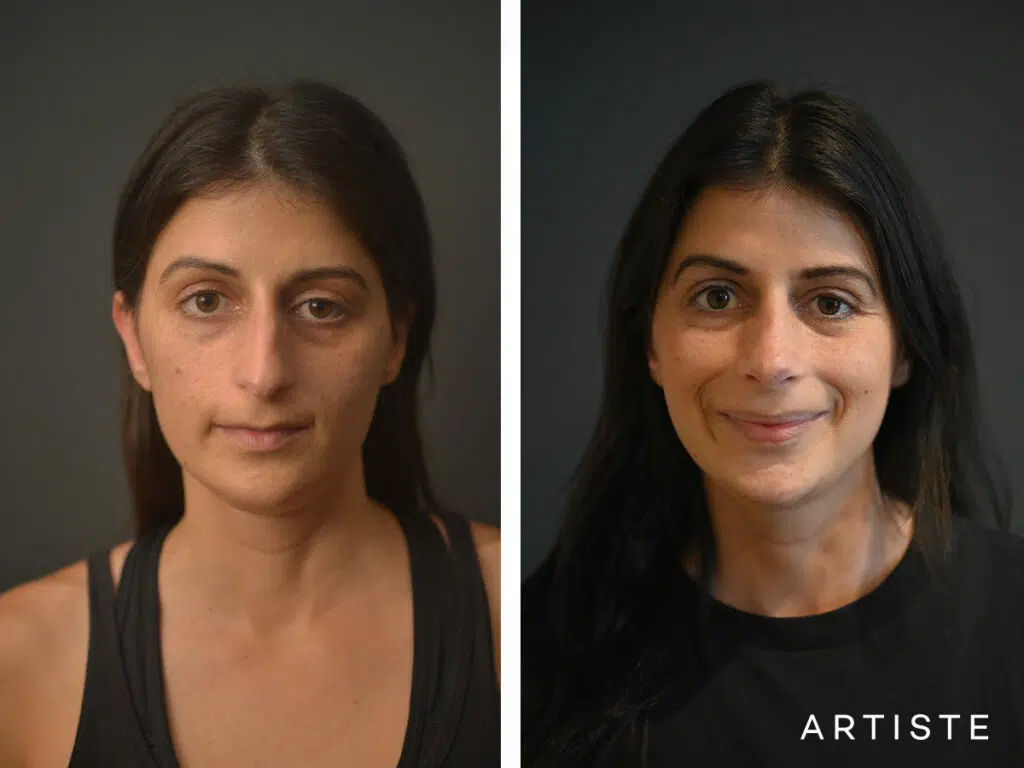 32 Years Old: + 12 months Post Open Structure Rhinoplasty