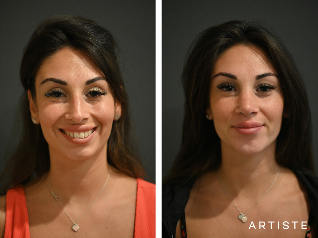 29 Years Old: 12 months Post Open Rhinoplasty and Chin (Implant) Augmentation