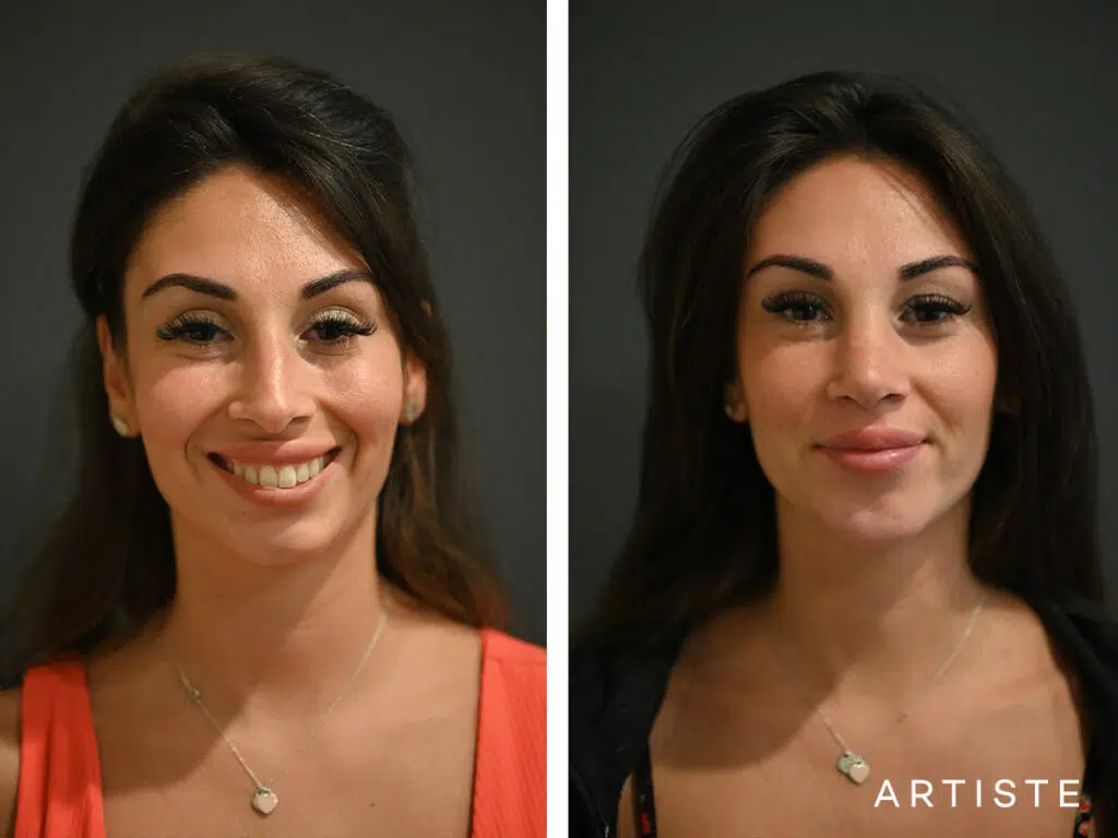 29 Years Old: 12 months Post Open Rhinoplasty and Chin (Implant) Augmentation