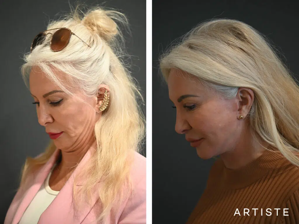 65 Years Old: Deep Plane Neck Lift and Upper Eyelid Blepharoplasty