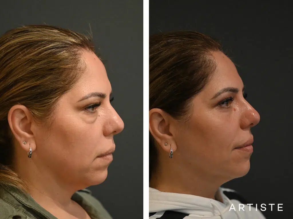 40 Years Old: Lower Eyelid Blepharoplasty