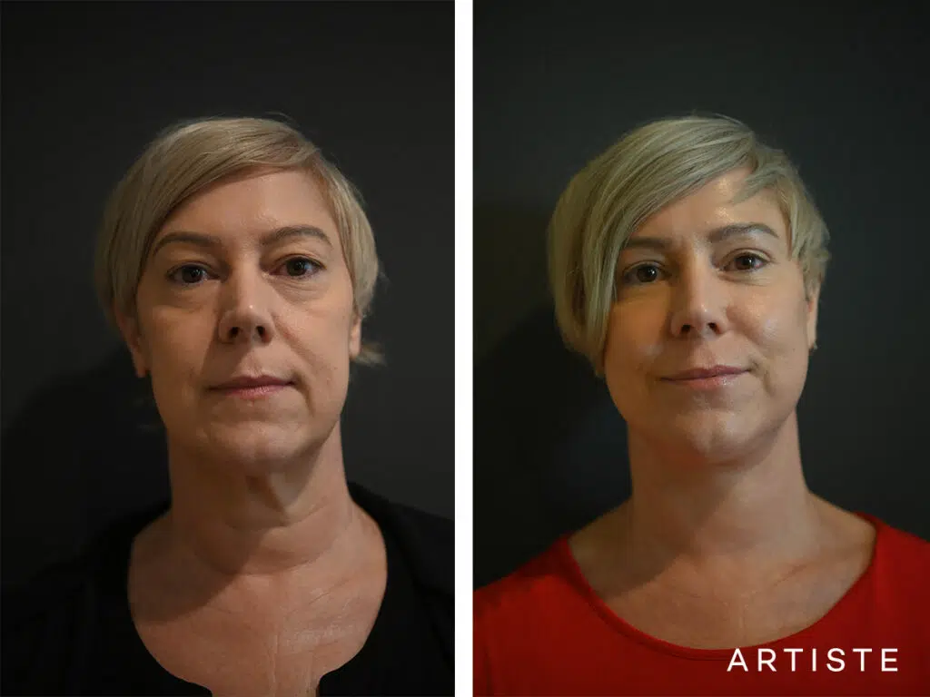 51 Years Old: Deep Plane Face and Neck Lift, Micro Fat Grafting and Bilateral Upper and Lower Eyelid Blepharoplasty