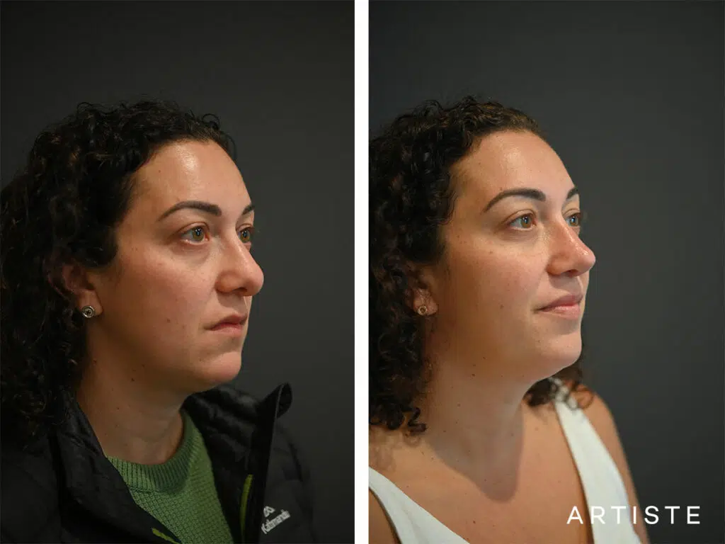 39 Years Old: Reconstructive Rib Graft Revision Rhinoplasty