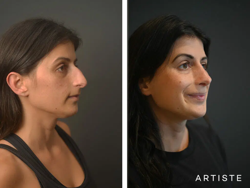 32 Years Old: + 12 months Post Open Structure Rhinoplasty