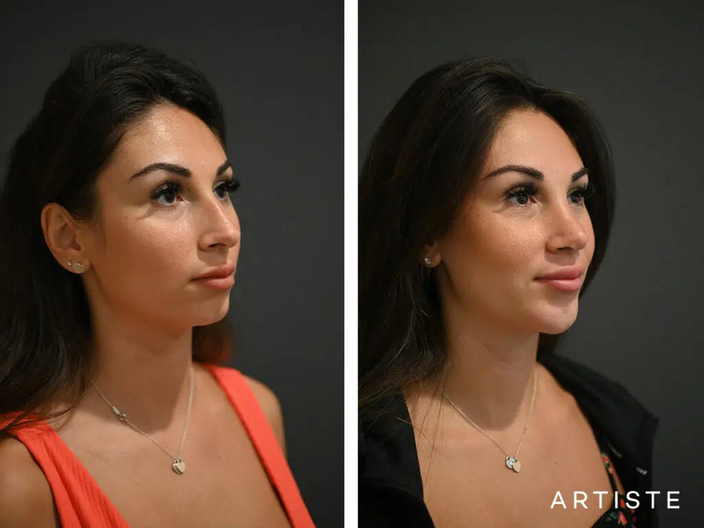 29 Years Old: 12 months Post Open Rhinoplasty and Chin (Implant) Augmentation