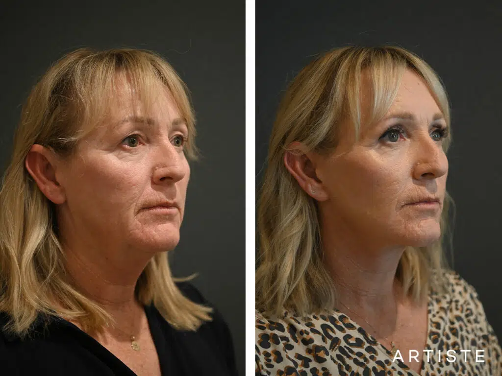 52 Years Old: Deep Plane Facelift, Micro Fat Grafting, Upper Eyelid Blepharoplasty, Peri-Oral Dermabrasion and Chemical Peel