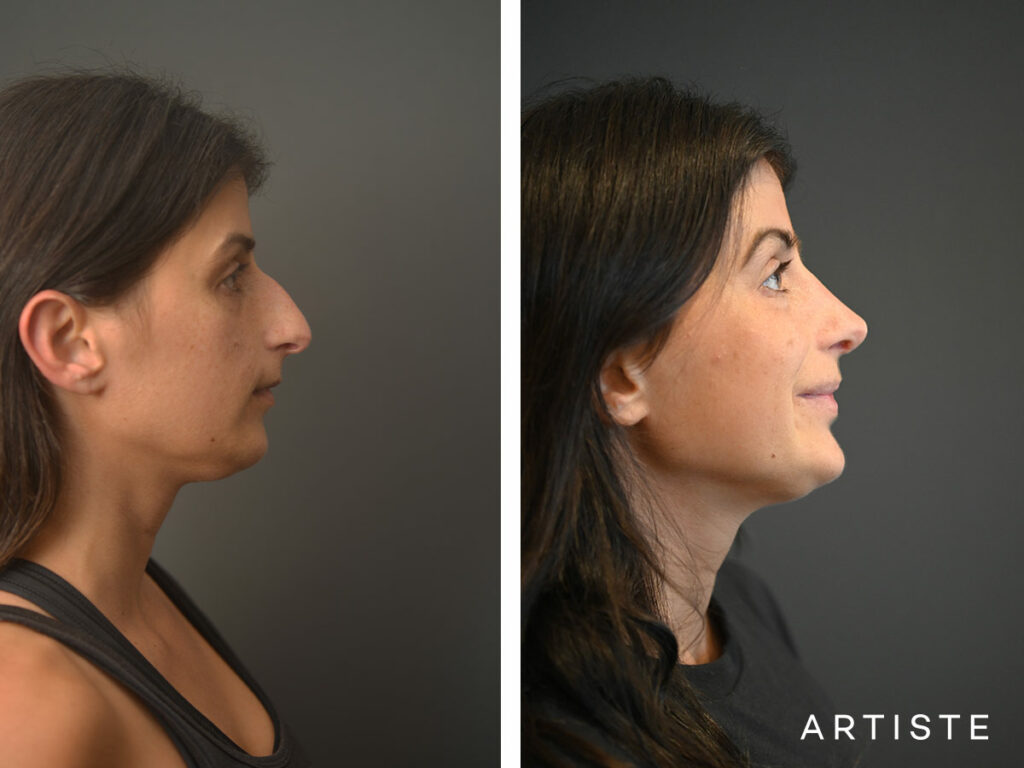 32 Years Old: + 12 months Post Open Structure Rhinoplasty