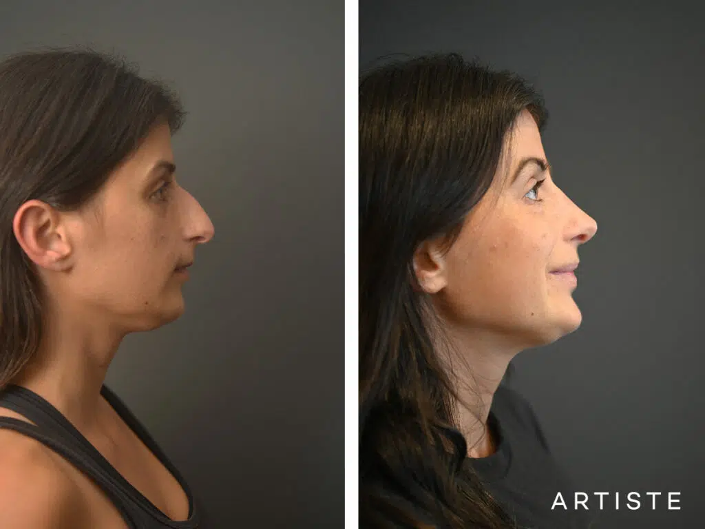 32 Years Old: + 12 months Post Open Structure Rhinoplasty