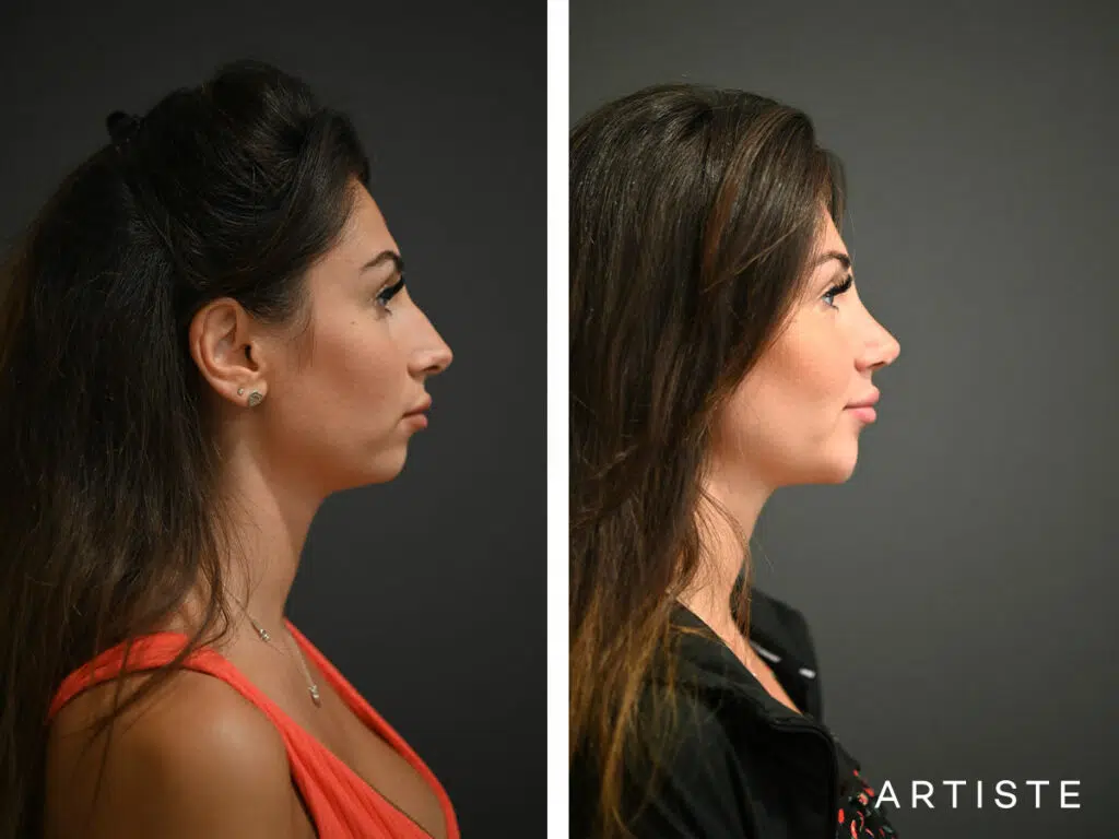 29 Years Old: 12 months Post Open Rhinoplasty and Chin (Implant) Augmentation