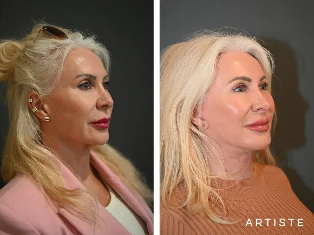 65 Years Old: Deep Plane Neck Lift and Upper Eyelid Blepharoplasty