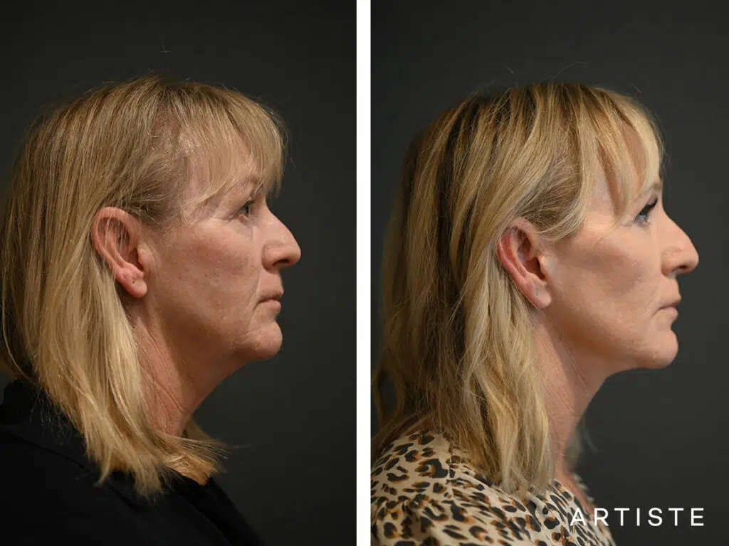 52 Years Old: Deep Plane Facelift, Micro Fat Grafting, Upper Eyelid Blepharoplasty, Peri-Oral Dermabrasion and Chemical Peel