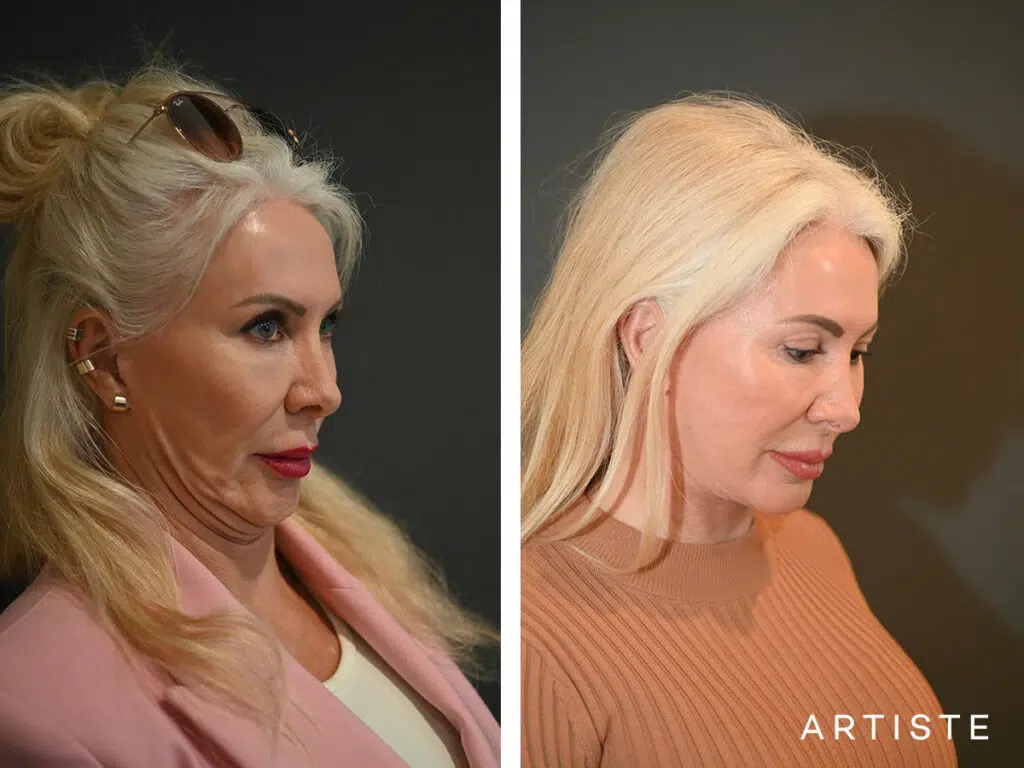 65 Years Old: Deep Plane Neck Lift and Upper Eyelid Blepharoplasty