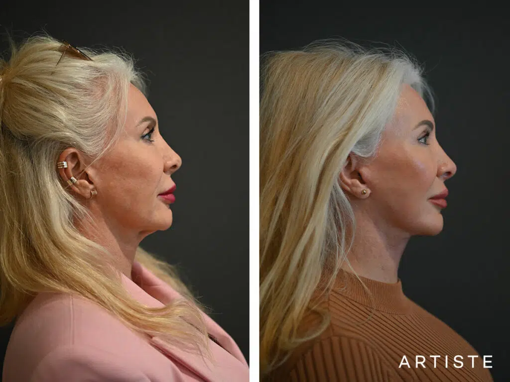 65 Years Old: Deep Plane Neck Lift and Upper Eyelid Blepharoplasty