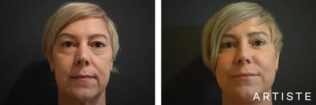 51 Years Old: Upper Eyelid and Lower Eyelid Transconjunctival Blepharoplasty, Deep Plane Facelift