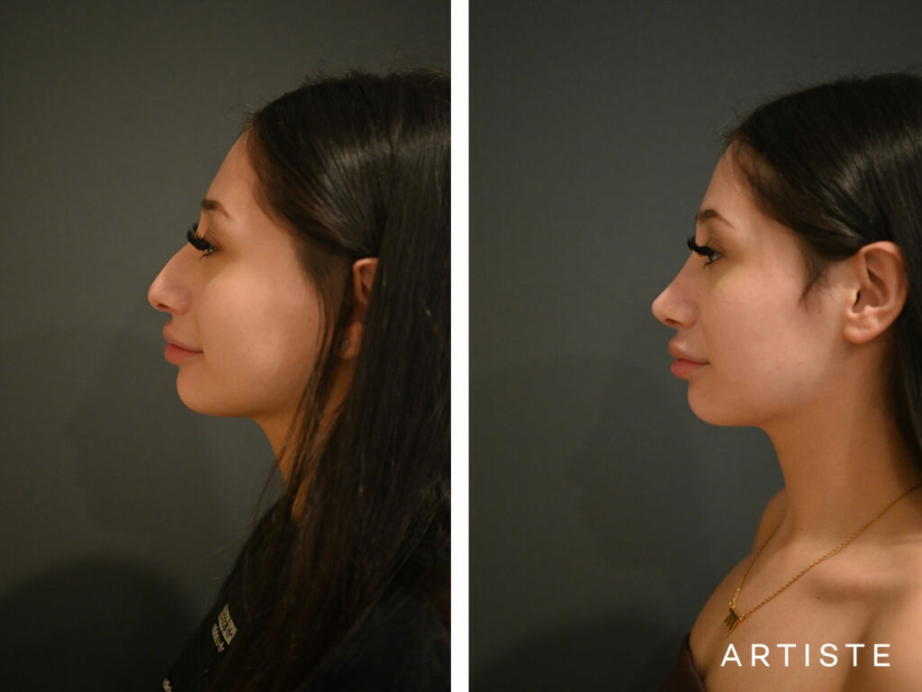 20 Years Old: 9 months Post Open Rhinoplasty