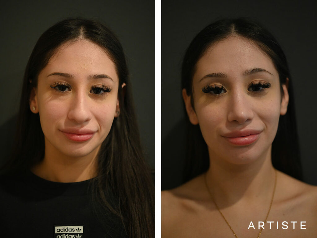 20 Years Old: 9 months Post Open Rhinoplasty
