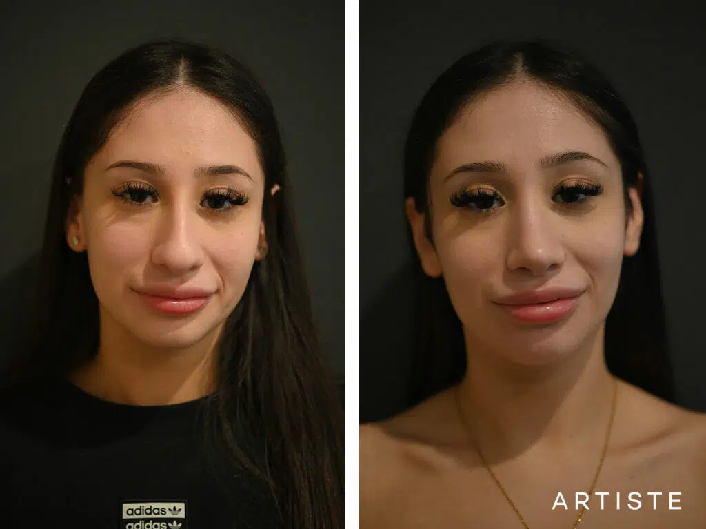 20 Years Old: 9 months Post Open Rhinoplasty