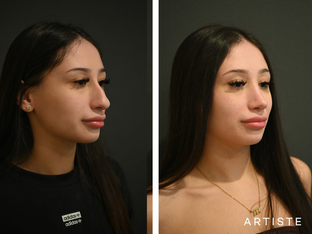 20 Years Old: 9 months Post Open Rhinoplasty