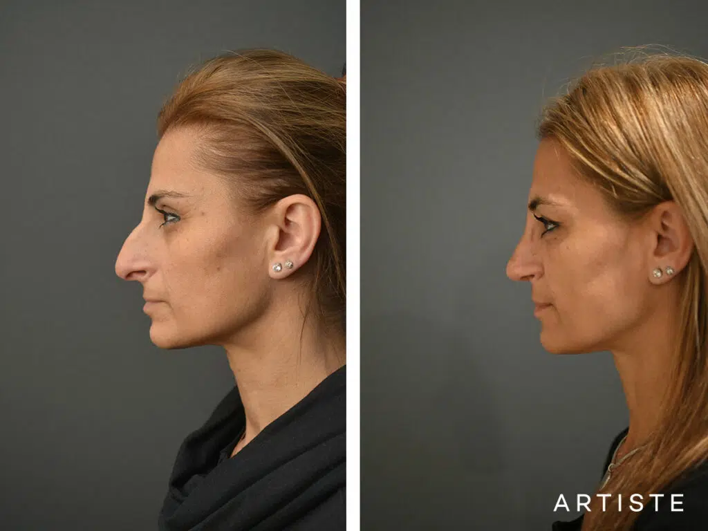 47 Years Old: Open Rhinoplasty