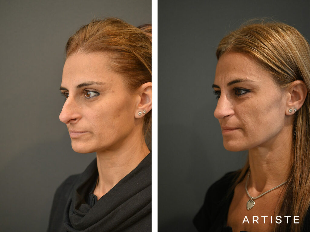 47 Years Old: Open Rhinoplasty