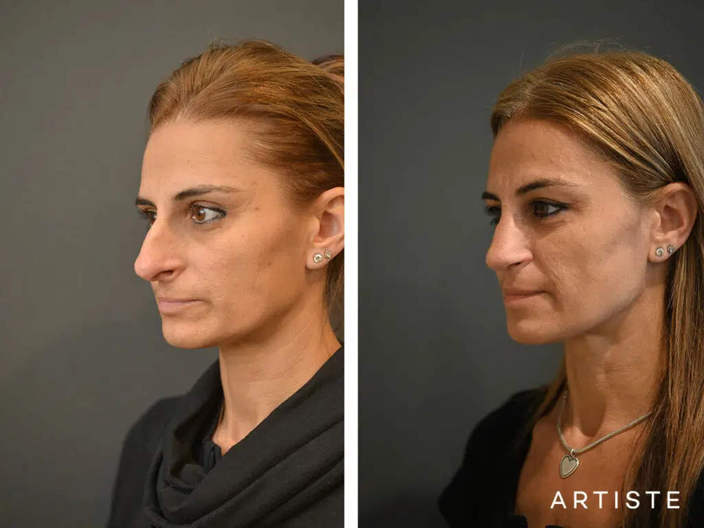 47 Years Old: Open Rhinoplasty