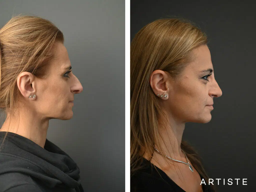 47 Years Old: Open Rhinoplasty